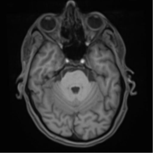 File:Cerebral metastasis - melanoma (Radiopaedia 54718-60954 Axial T1 17).png
