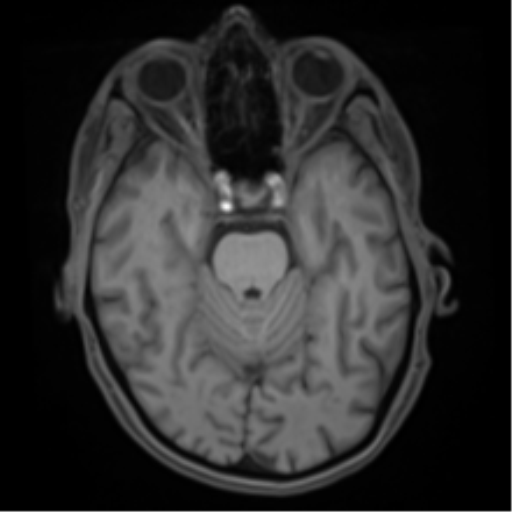 File:Cerebral metastasis - melanoma (Radiopaedia 54718-60954 Axial T1 19).png