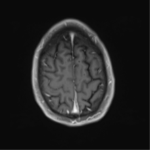 File:Cerebral metastasis - melanoma (Radiopaedia 54718-60954 Axial T1 C+ fat sat 45).png