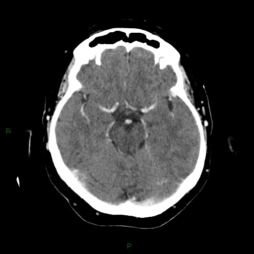 File:Cerebral metastasis from renal cell carcinoma (Radiopaedia 82306-96375 Axial C+ delayed 14).jpg