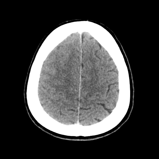 Cerebral metastasis to basal ganglia (Radiopaedia 81568-95412 Axial C+ delayed 46).png