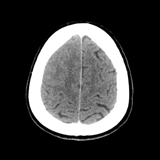 Cerebral metastasis to basal ganglia (Radiopaedia 81568-95412 Axial C+ delayed 47).png
