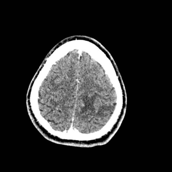 File:Cerebral toxoplasmosis (Radiopaedia 53993-60131 Axial C+ delayed 62).jpg