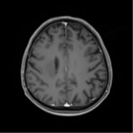 Cerebral toxoplasmosis (Radiopaedia 54575-60804 Axial T1 C+ 39).png