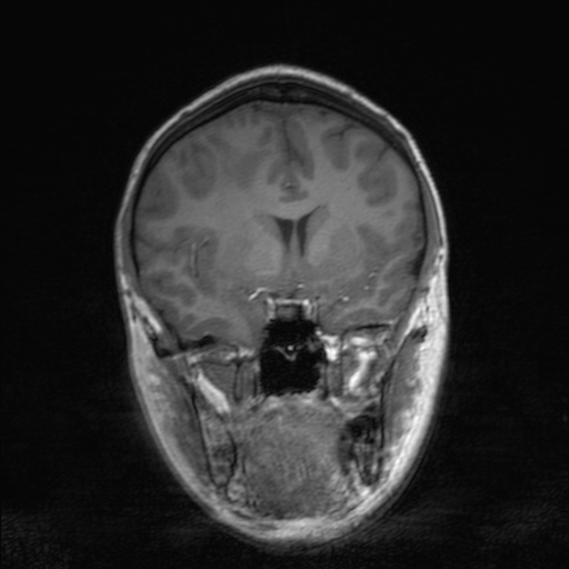 Cerebral tuberculosis with dural sinus invasion (Radiopaedia 60353-68090 Coronal T1 79).jpg