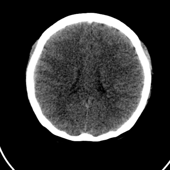 File:Cerebral venous hemorrhagic infarct from venous sinus thrombosis (Radiopaedia 55433-61879 Axial non-contrast 15).jpg