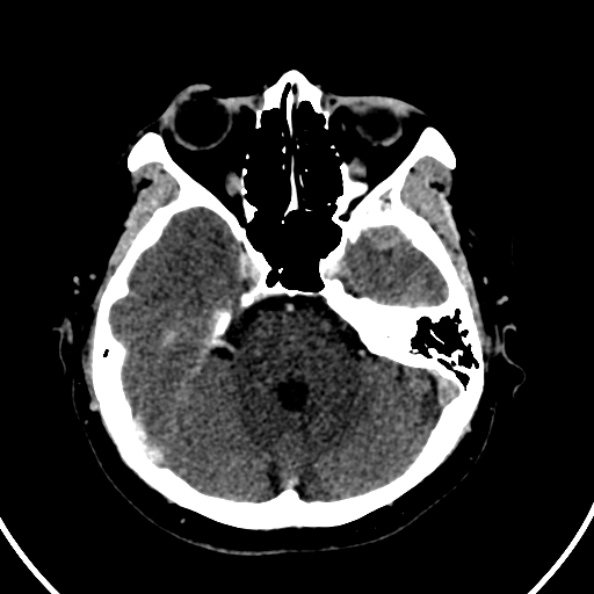 File:Cerebral venous hemorrhagic infarct from venous sinus thrombosis (Radiopaedia 55433-61883 Axial C+ delayed 108).jpg