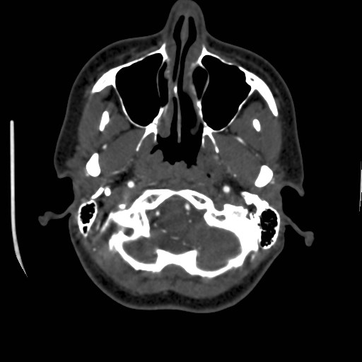 Cerebral venous sinus thrombosis (Radiopaedia 40619-43227 A 25).jpg