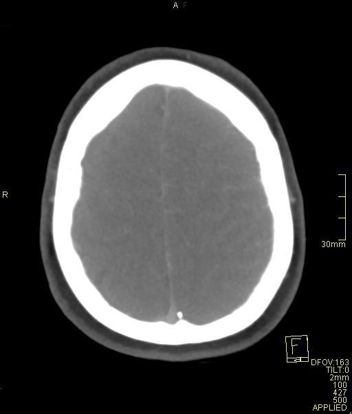 Cerebral venous sinus thrombosis (Radiopaedia 91329-108965 Axial venogram 66).jpg