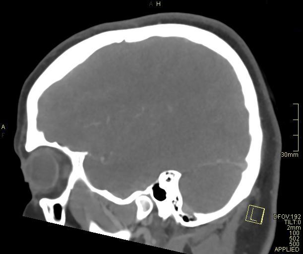 Cerebral venous sinus thrombosis (Radiopaedia 91329-108965 Sagittal venogram 20).jpg