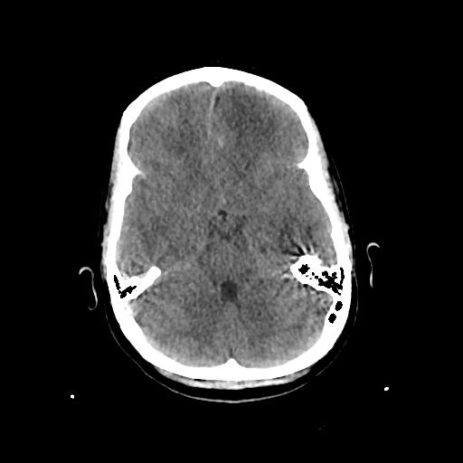 Cerebral venous throbmosis - hemorrhagic venous infarction (Radiopaedia 87318-103613 Axial non-contrast 53).jpg