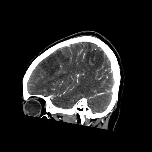 File:Cerebral venous throbmosis - hemorrhagic venous infarction (Radiopaedia 87318-103613 Sagittal CT venogram 9).jpg