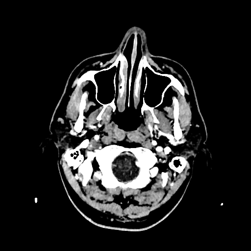 File:Cerebral venous thrombosis (CVT) (Radiopaedia 77524-89685 Axial with contrast 3).jpg