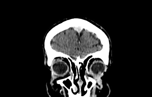 File:Cerebral venous thrombosis (CVT) (Radiopaedia 77524-89685 C 4).jpg