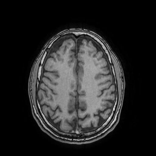 File:Cerebral venous thrombosis with secondary intracranial hypertension (Radiopaedia 89842-106957 Axial T1 124).jpg