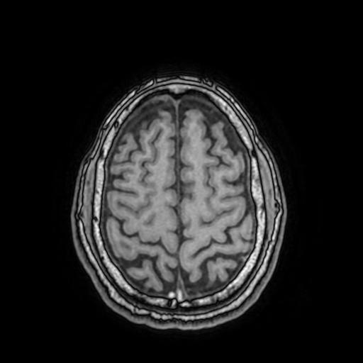 File:Cerebral venous thrombosis with secondary intracranial hypertension (Radiopaedia 89842-106957 Axial T1 136).jpg