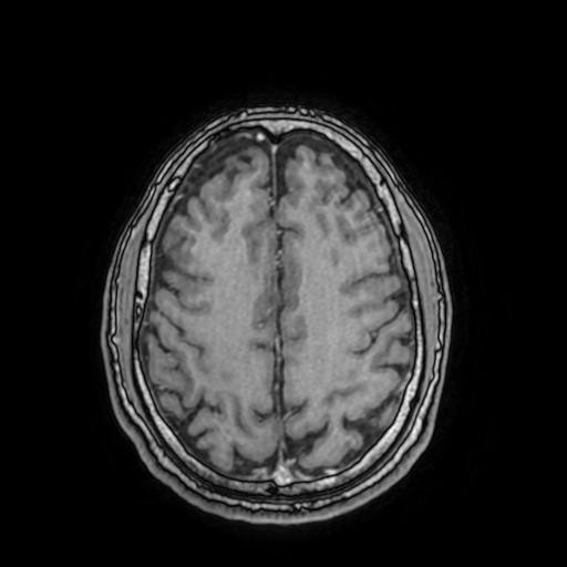 File:Cerebral venous thrombosis with secondary intracranial hypertension (Radiopaedia 89842-106957 Axial T1 C+ 128).jpg