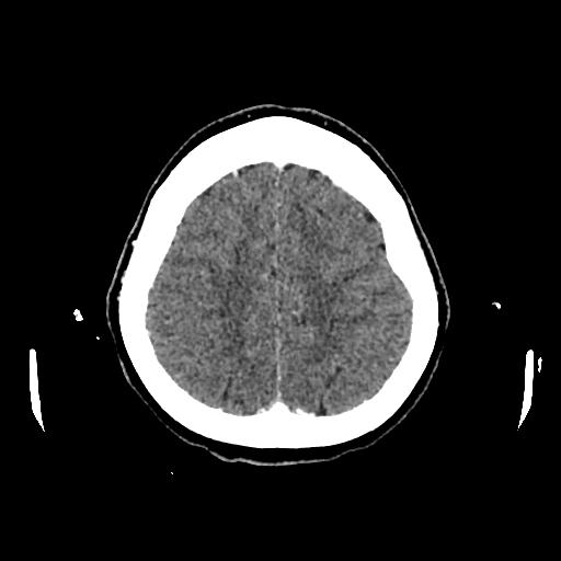 Cerebral venous thrombosis with venous hemorrhagic infarct (Radiopaedia 90354-107660 Axial with contrast 132).jpg
