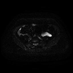Cervical carcinoma (Radiopaedia 85405-101028 Axial DWI 19).jpg