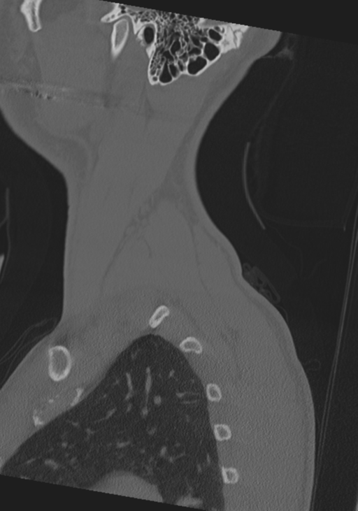 Cervical intercalary bone (Radiopaedia 35211-36748 Sagittal bone window 5).png