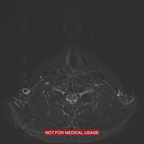 Cervical nerve schwannoma (Radiopaedia 27964-28221 C 39).jpg