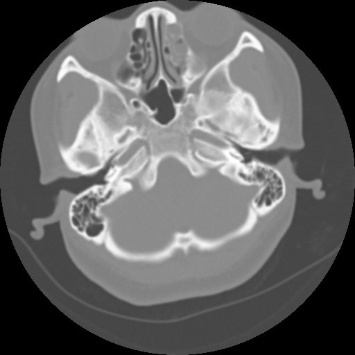 Cervical rib (Radiopaedia 71110-81363 Axial non-contrast 9).jpg