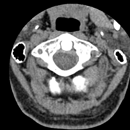 File:Cervical spinal neurofibroma in a patient with NF1 (Radiopaedia 58344-65464 Axial non-contrast 14).jpg