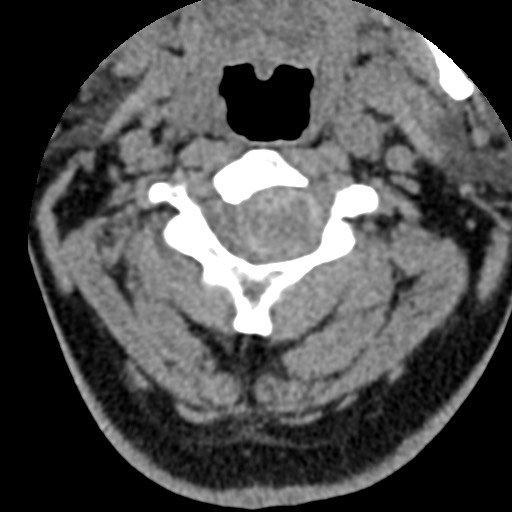 File:Cervical spinal neurofibroma in a patient with NF1 (Radiopaedia 58344-65464 Axial non-contrast 25).jpg