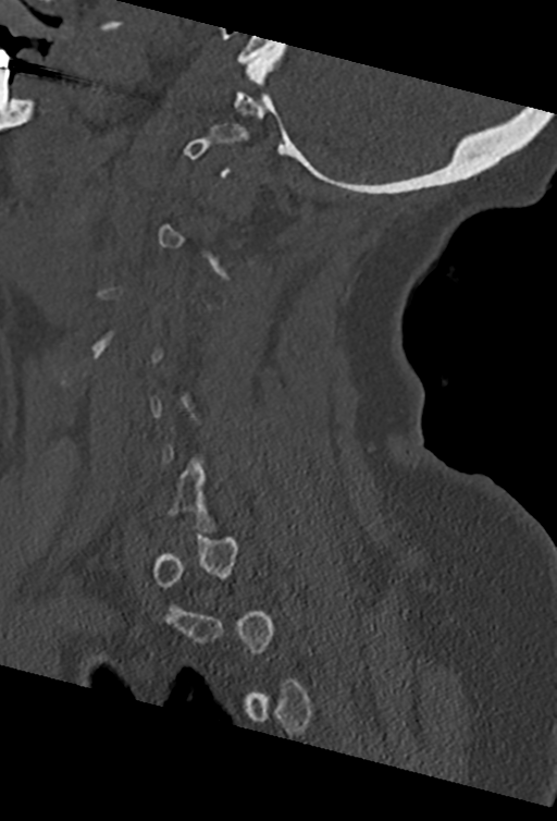 Cervical spine ACDF loosening (Radiopaedia 48998-54070 Sagittal bone window 62).png