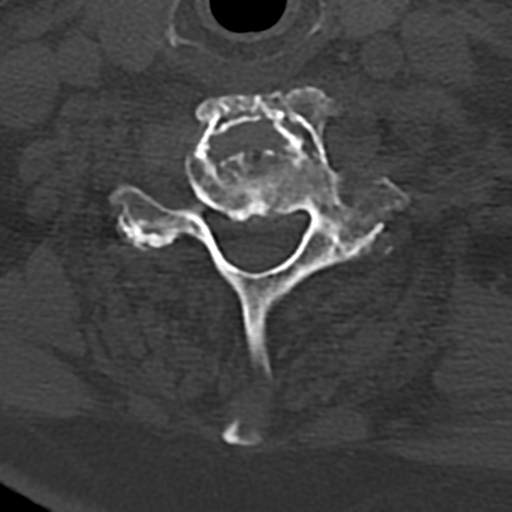 File:Cervical spine fracture - chalk stick (Radiopaedia 39116-41323 Axial bone window 69).png