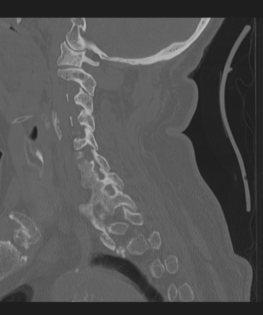 Cervical spine fracture in the setting of ankylosis (Radiopaedia 37038-38715 Sagittal bone window 30).png