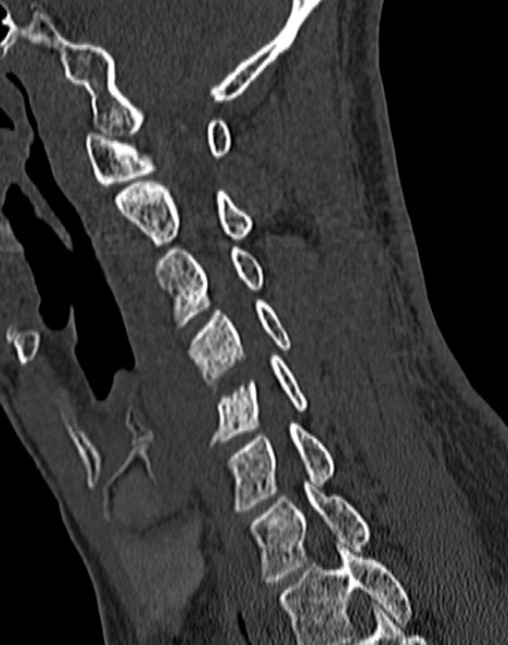 Cervical spondylodiscitis (Radiopaedia 28057-29489 Sagittal bone window 40).jpg