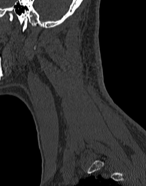 Cervical spondylodiscitis (Radiopaedia 28057-29489 Sagittal bone window 56).jpg