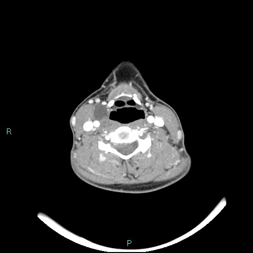 Cervical thymic cyst (Radiopaedia 88632-105335 B 57).jpg