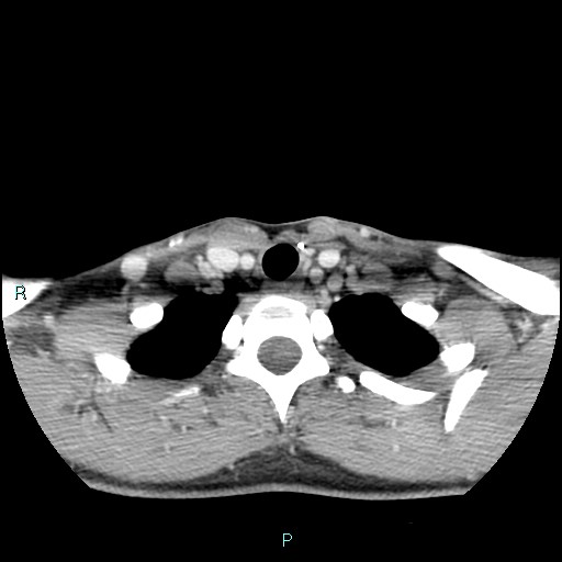 Cervical thymic cyst (Radiopaedia 88632-105335 C 32).jpg