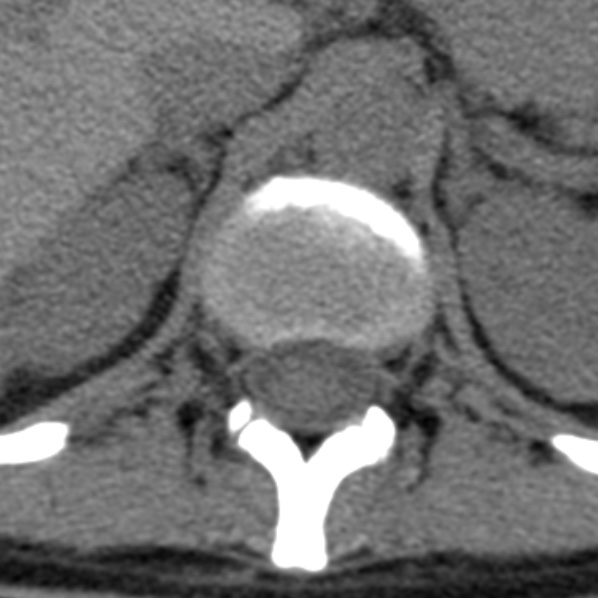 Chance fracture (Radiopaedia 36521-38081 Axial non-contrast 61).jpg