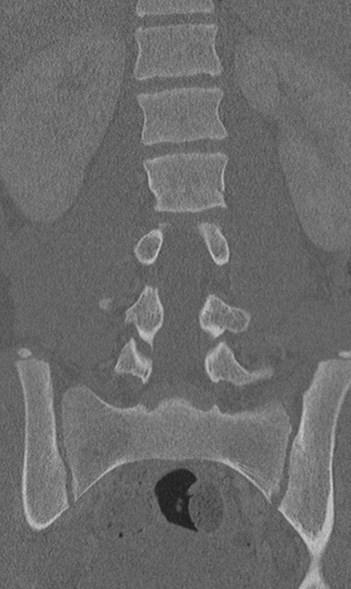 Chance fracture (Radiopaedia 40360-42912 Coronal bone window 36).png