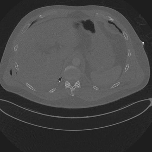 Chest multitrauma - aortic injury (Radiopaedia 34708-36147 Axial bone window 276).png
