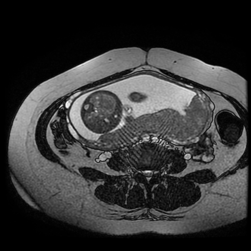 Chiari II malformation - fetal MRI (Radiopaedia 68099-77581 Axial Fiesta 14).jpg