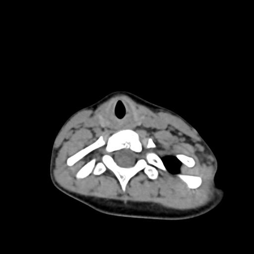 Chiari I with syrinx and skull base anomalies (Radiopaedia 89444-106412 Axial non-contrast 110).jpg
