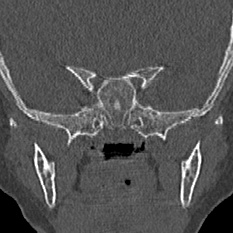 Choanal atresia (Radiopaedia 88525-105975 Coronal bone window 91).jpg