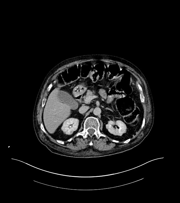 Cholangiocarcinoma with cerebral metastases (Radiopaedia 83519-98629 Axial C+ delayed 37).jpg
