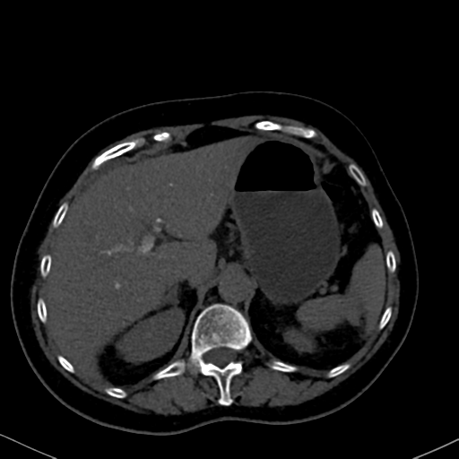 File:Cholecystitis - obstructive choledocholitiasis (CT intravenous cholangiography) (Radiopaedia 43966-47479 Axial 97).png