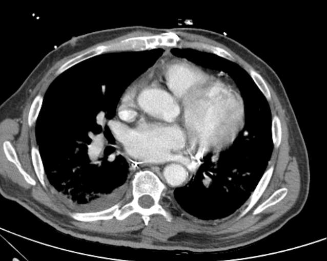 Cholecystitis - perforated gallbladder (Radiopaedia 57038-63916 A 2).jpg