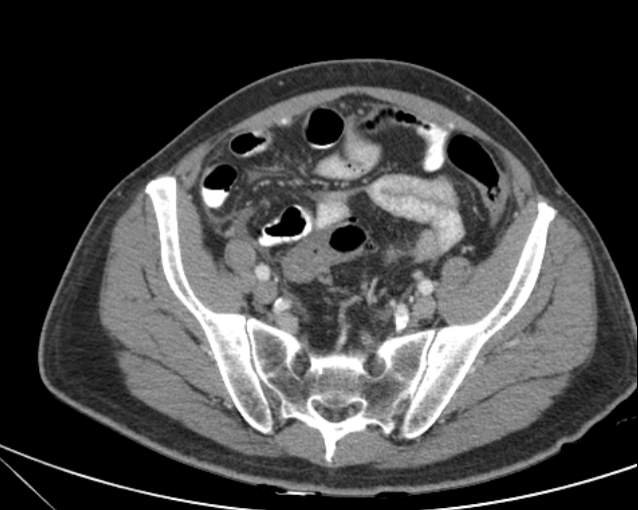 Cholecystitis - perforated gallbladder (Radiopaedia 57038-63916 A 65).jpg
