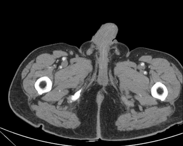 Cholecystitis - perforated gallbladder (Radiopaedia 57038-63916 A 90).jpg