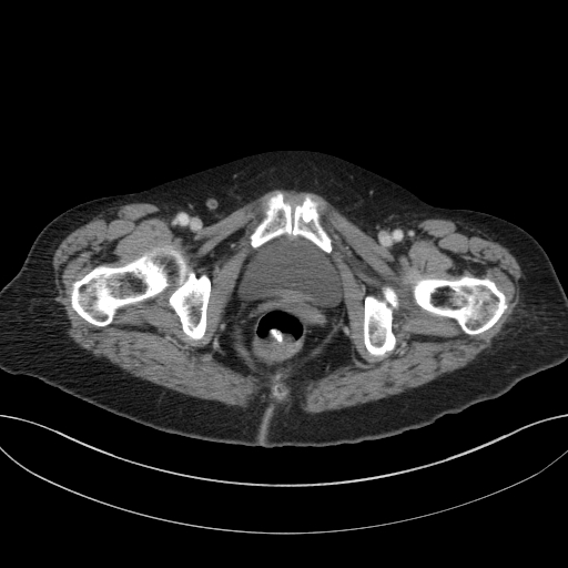 Cholecystoduodenal fistula due to calculous cholecystitis with gallstone migration (Radiopaedia 86875-103077 D 80).jpg