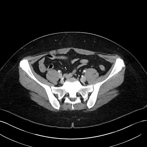 File:Choledocholithiasis after recent cholecystectomy (Radiopaedia 60929-68737 Axial 26).jpg