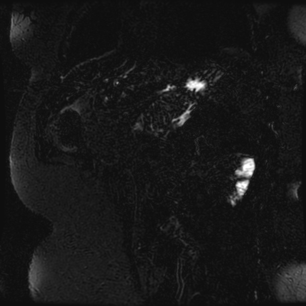 Choledocholithiasis on CT and MRI (Radiopaedia 24825-25088 Coronal T2 91).jpg