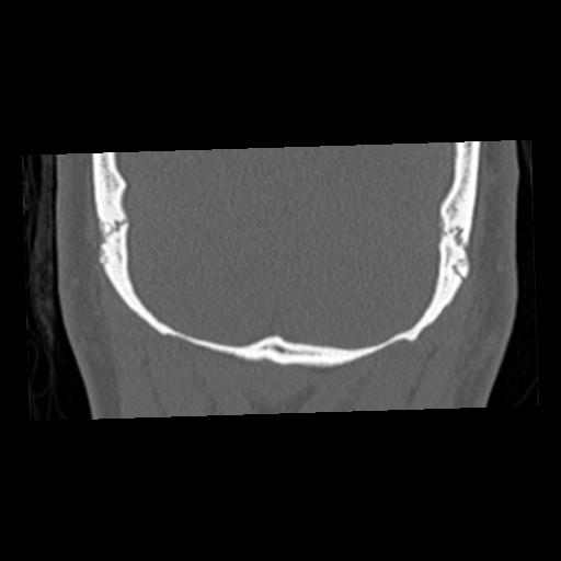 Cholesteatoma (Radiopaedia 84960-100474 Coronal bone window 76).jpg